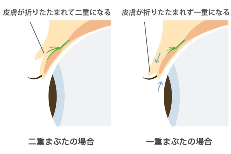 二重埋没法　手術方法02